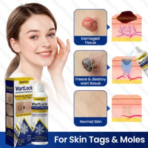 Healrize®WartLock Cryo-Recovery Cooling Spray