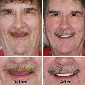 BQYOOMTM Custom-Fit Full Functional Dentures