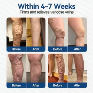 Glorenda® Vein Contour Microneedle Patch