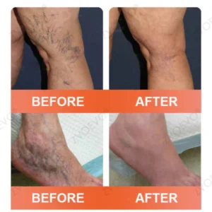 Zvoevo® Vein Ease Microneedle Care Patch