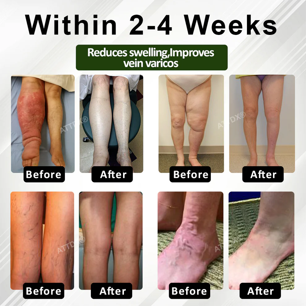 ATTDX® FluidEase Leg Therapy Edema Cream