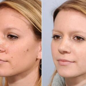 AURORA™ WartAway Wart Removal Ointment