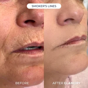 Glamory Microlift System