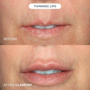 Glamory Microlift System