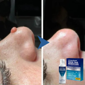 WartRelief Skin Tag Remover