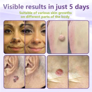 GFOUK® Soluble Microneedle Botanical Skin Tag Removal Patch