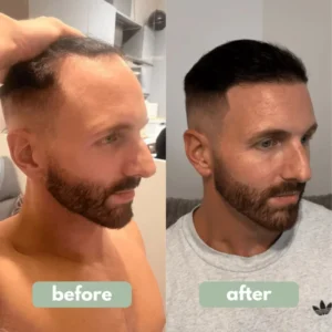 Reverse – Hair Growth Serum